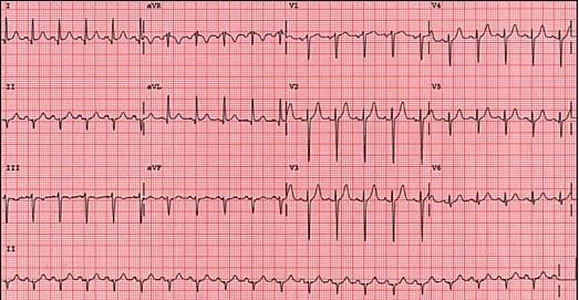 Left Anterior Fascicular Block Left Axis Deviation (usually < - 35 degrees) Small Q waves in leads I and avl; S > R waves in leads II,