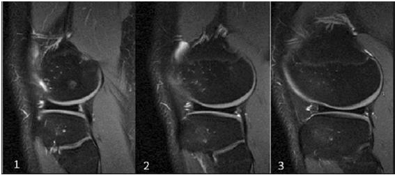 Discoid Meniscus Evaluation Congenital anomaly resulting in an abnormal size, shape and attachment, almost always affecting the lateral meniscus Wantanabe Classification: Complete (1), Incomplete