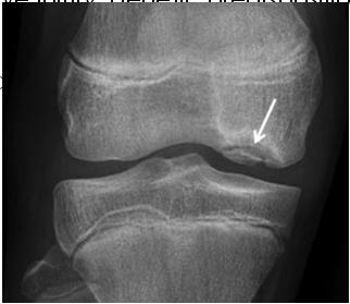 Anatomic Considerations Surgical Approaches Tibial tubercle-trochlear groove distance Trochlear dysplasia Patella Alta Femoral Anteversion External Tibial Torsion Genu Valgum Generalized ligamentous