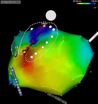 Left Atrial-Pulmonary Vein Reentrant Tachycardia PA LL Map Map Lasso Lasso His CS CS His Figure 1.