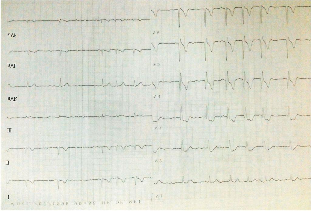 Atrial Fibrillation in Brugada Syndrome Figure 1. An example of 12-lead electrocardiogram in a Brugada syndrome (BrS) patient with atrial fibrillation (AF). 16 vs. 45 14, p = 0.67).