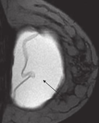 The pathologic specimen from lumpectomy yielded only a 6-mm focus of residual tumor. The baseline MRI shows a large enhancing mass (Fig.