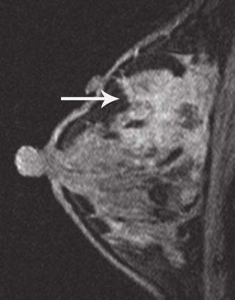 Indications for Breast MRI Fig. 8 43-year-old woman with newly diagnosed breast cancer.