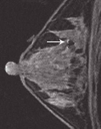 B, Obtained after patient had completed neoadjuvant chemotherapy, contrast-enhanced sagittal fatsuppressed T1-weighted image of right breast reveals that tumor is no longer visible by MRI.
