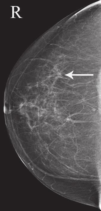 Argus and Mahoney When suspicious or indeterminate findings are identified by mammography, sonography, or clinical breast examination, a negative breast MRI does not exclude the need for a biopsy.