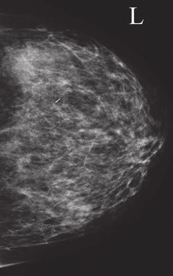 Multiple studies using MRI have shown detection rates ranging from 62% to 86% for identifying an occult primary breast cancer in patients presenting with axillary lymph node metastases [2, 7]. A Fig.