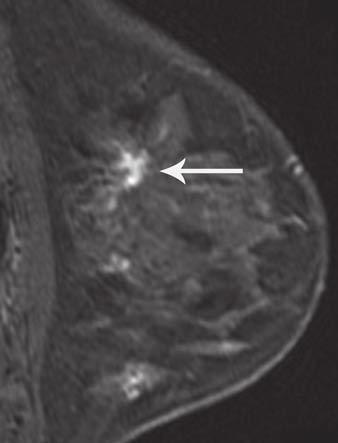 A and B, Mediolateral oblique (A) and craniocaudal (B) views of left breast from digital mammography show heterogeneously dense parenchyma.
