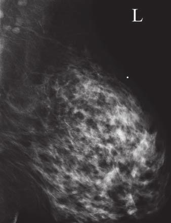 Argus and Mahoney where the patient pointed out a palpable mass (Figs. 4A and 4B). The breast parenchyma is heterogeneously dense. No mammographic abnormality is evident.