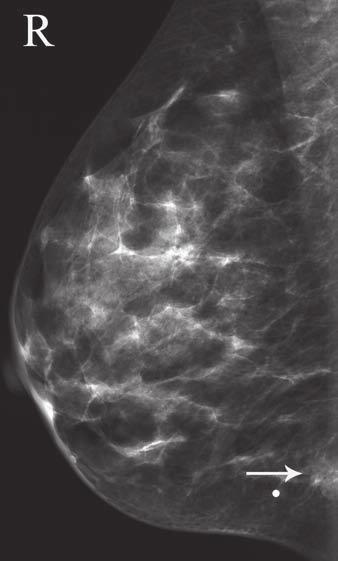 Indications for Breast MRI Scenario 5 A 65-year-old woman presented with complaints of a palpable mass in her right breast.