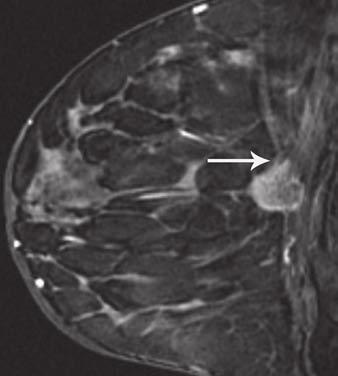 Ultrasound-guided biopsy revealed invasive ductal carcinoma. Preoperative breast MRI was then performed. Fig. 5 65-year-old woman with palpable mass in lower medial right breast.