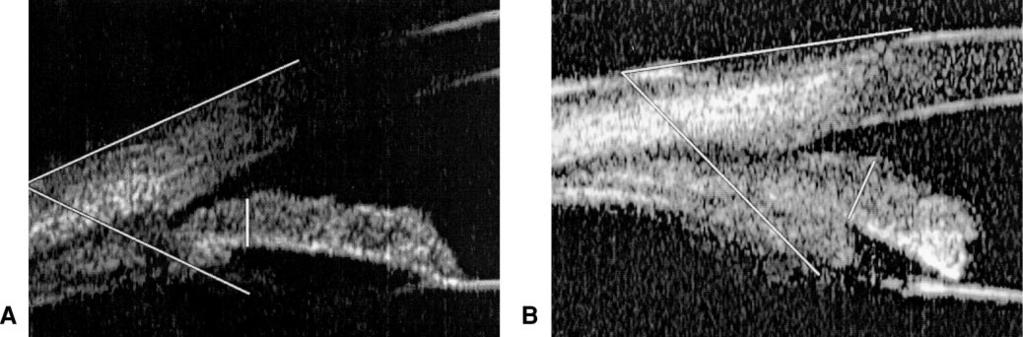 288 Marchini et al. IOVS, January 2003, Vol. 44, No. 1 FIGURE 4. Iris and sclera ciliary process angle before (A) and after (B) treatment with 2% ibopamine.
