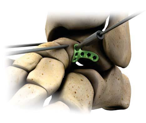 Implant Positioning Select the.4mm VLP MINI-MOD Talus plate that best accommodates the patient s anatomy and fracture pattern.