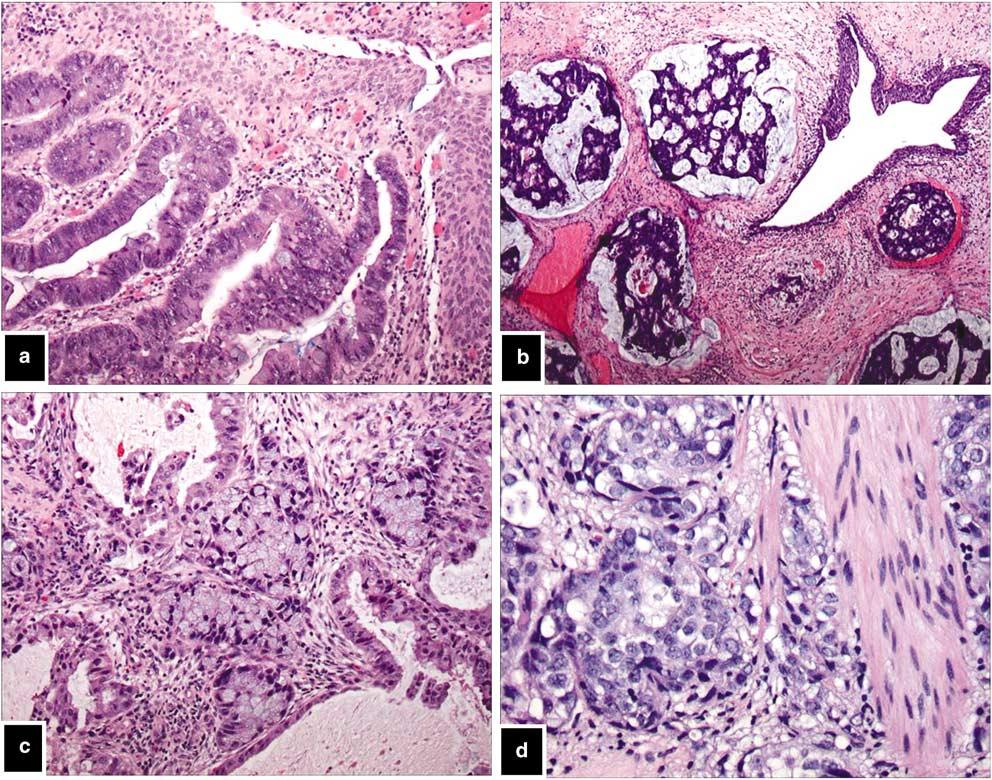 Urovysiont fluorescence in situ hybridization 123 Figure 2 Bladder wall involved by (a) colonic adenocarcinoma (hematoxylin and eosin, 100), (b) primary mucinous adenocarcinoma (hematoxylin and