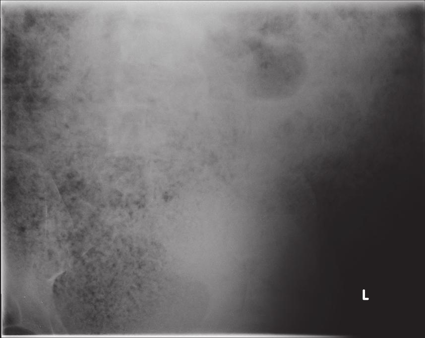 2 Case Reports in Surgery Figure 1: Plain preoperative abdominal radiograph. Figure 2: Plain preoperative erect chest radiograph. diffuse tenderness although there was no obvious peritonism.