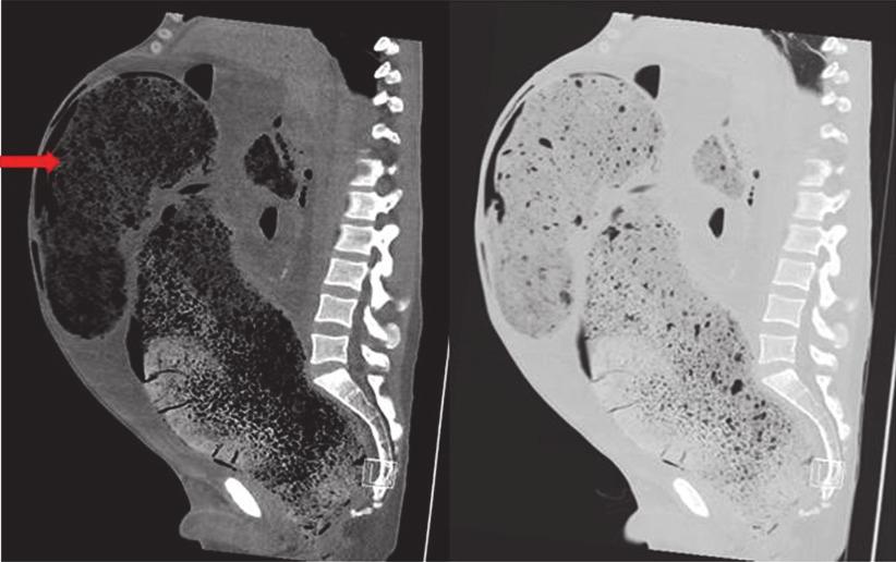 Case Reports in Surgery 3 Figure 3: Sagittal MPR CT images with soft tissue windows on the left and lung windows on the right.