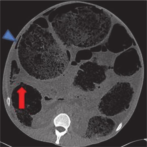 Figure 4: Axial CT images on soft tissue windows showing the anterior ascending colon perforation site (arrow). The ascending colon has collapsed a little relative to the distal bowel.