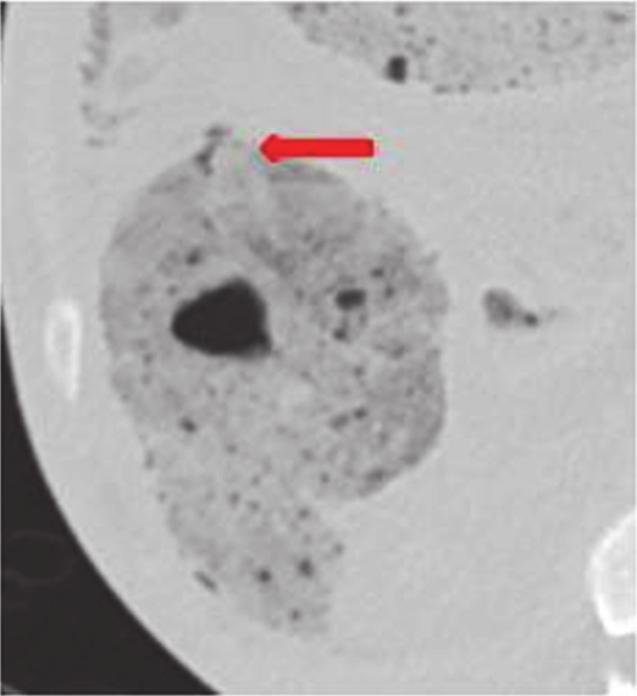 Figure 6: Axial CT images on lung windows confirming small pockets of free gas adjacent to the perforation site.