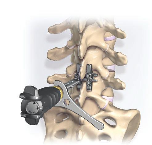 Note: If a significant compressive or distractive load was applied to the implant, there may be residual tension within the inserter/adjuster, which may make loosening the locking nut more difficult.