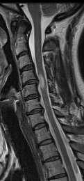 cord behave as CIS Spinal cord patients