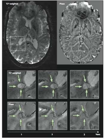 periventricular regions BUT this influence does not lead to an earlier diagnosis of lesion dissemination in time and therefore definite MS.
