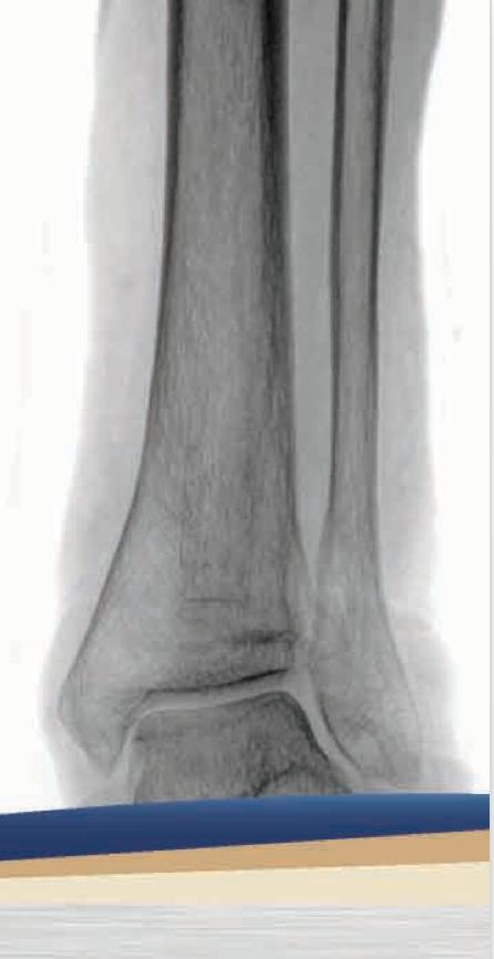 Ankle Fractures Elizabeth