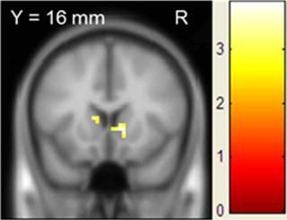Near Misses Near-misses were associated with significantly greater signal in the ventral striatum and anterior insula Recruitment of win-related regions during