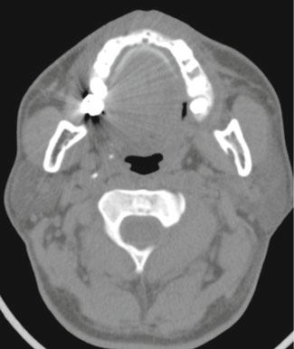 316 Emerg Rdiol (2013) 20:311 322 Tle 1 MDCT protocols for evluting impcted FB Body region Scn rnge Tue voltge/current Contrst Slice thickness Neck Thorx Adomen nd pelvis Floor of mxillry sinus to