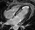 Powerful Technology to Detect Biological Signals: MRI and TDI Analysis Infarct Transmurality & Segmental Contraction LV Coronary occlusion 2 min 6 min 3h >6h AVO Baseline Strain Septum (%) AVC base