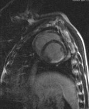 Progenitor Cell-type Specific Biological Effects in Infarcted Porcine Heart MRI: 15 min after iv Gd-PTPA LVEF (%) 7 6 5 4 3 2 1 +5.2% +6.4% +3.