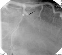 dysfunction post PCI Informed
