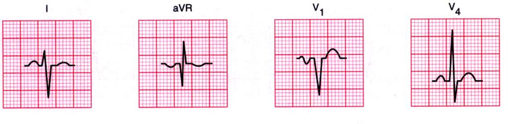 The QRS complexes are reaching toward eachother, so Right axis.