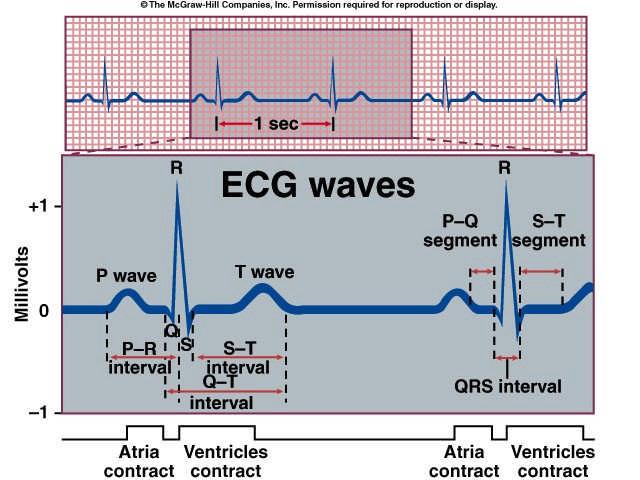 Interpretation of ECG Normal Sinus Rhythm Rate: 60-100 b/min Rhythm: