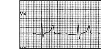 Cardiac Manifestations ECG changes: peaked T Loss of P wave Widened QRS Dysrhythmias AV blocks V-fib Asystole