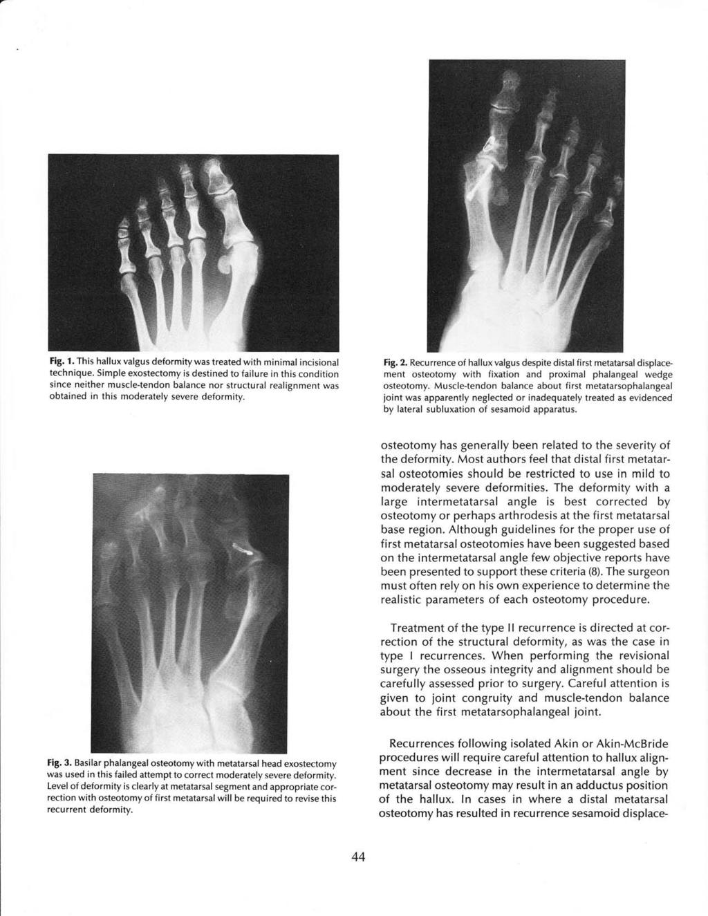 Fig. 1. This hallux valgus deformity was treated with minimal incisional technique.