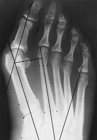 Correction of the deformity requires a proximal base wedge osteotomy owing to the lack of flexibility (rigid deformity) in order to reduce the intermetatarsal angle and restore a more normal