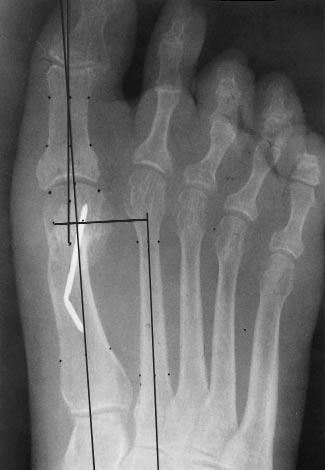 valgus deformity with a distal metaphyseal osteotomy. Reference lines are shown. A B Figure 5.