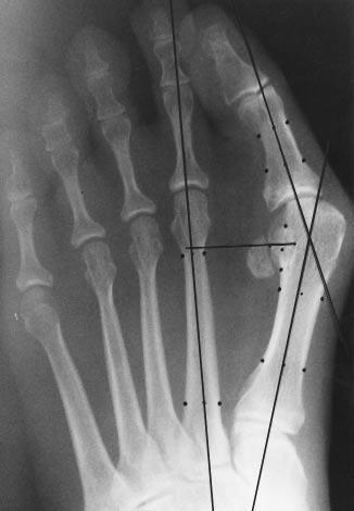 deformity with a McBride-Austin bunionectomy including the excision of the fibular sesamoid to restore normal musculotendinous function around the