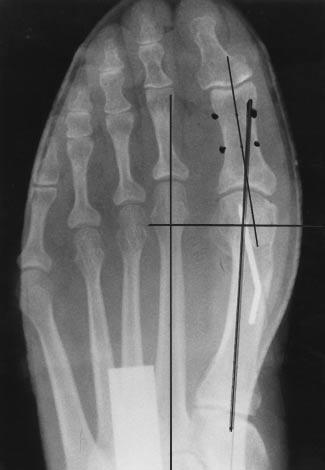 Note the excellent reduction of the deformity, especially the intermetatarsal angle and sesamoid position as well as the correction of the hallux
