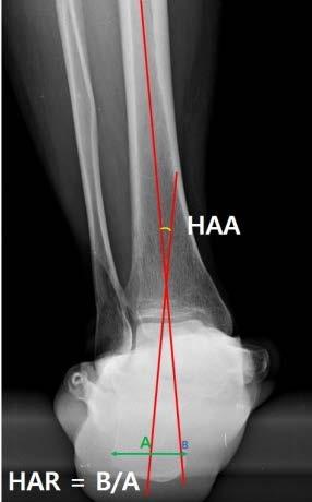 Tarso-1 st metatarsal angle (Meary angle) 6. Calcaneal pitch angle (CPA) for degree of Pes planus correction 7.