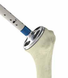 A Simple Solution The first of its kind, the Aequalis PerFORM glenoid system offers implants with multiple backside curvatures to better match arthritic anatomy.