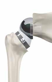 Grammont Aequalis ASCEND FLEX Optimized Rotation The 145 humeral inclination of the Aequalis Ascend Flex lateralizes the humerus