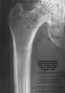 Pre-operative Planning chapter NOTE: Accurate pre-operative templating requires good quality standardized radiographs of the pelvis and operative hip. Determine leg length discrepancy.