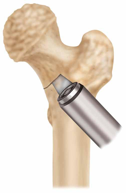 Surgical Technique chapter 2 Femoral Neck Osteotomy Using the greater trochanter or lesser trochanter as a