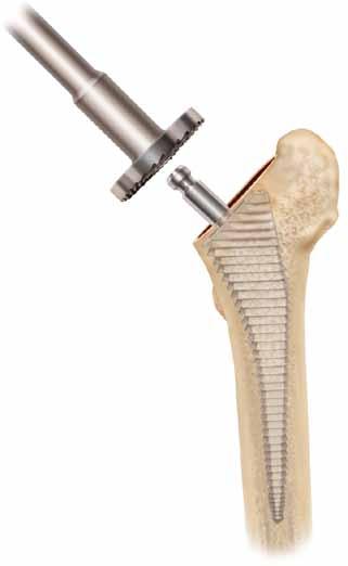 If a broach smaller than the size templated becomes tight, hard bone at the lateral femoral neck may be pushing the broach into varus. Use the lateral edge of the broach to restore a neutral position.