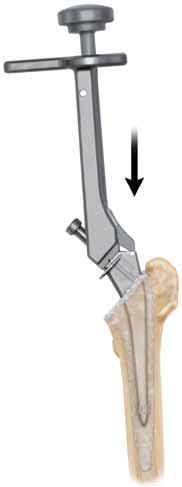 Stem Insertion (continued) Cemented The femoral bone bed is cleaned and bone cement is prepared and introduced into the femoral canal according to standard recommendations.