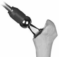 By resting the patient s knee against the mid-section of the assistant, this will provide counter-force against the mallet blows to ensure the impaction load