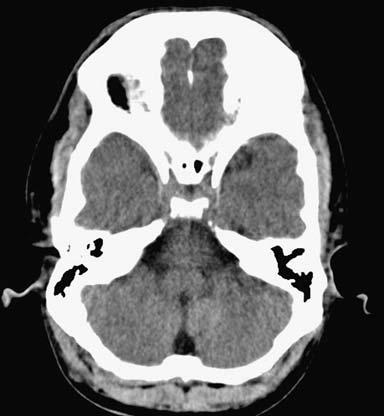 1725 Fig. 1 Infratentorial section of an unenhanced cranial CT scan acquired with a single-slice CT in a 68-year-old male patient stroke patients.