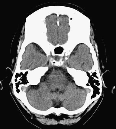 neurological for quite some time. Contrast-enhanced CT methods such as CT perfusion and/or CT angiography may further augment the diagnostic value of non-enhanced cranial CT.