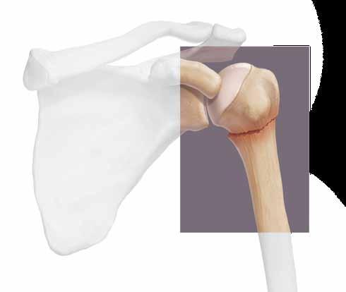 Percutaneous Humeral Fracture Repair Closed reduction followed by percutaneous fixation reduces risk from soft tissue dissection and may reduce the fracture indirectly, achieving provisional fixation
