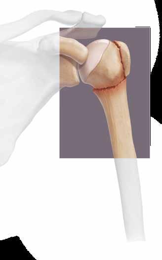 Three and Four-Part Valgus Impacted Humeral Fracture Valgus impacted three and four-part fractures are ideal for percutaneous repair as they have little or no medial displacement, preserving the